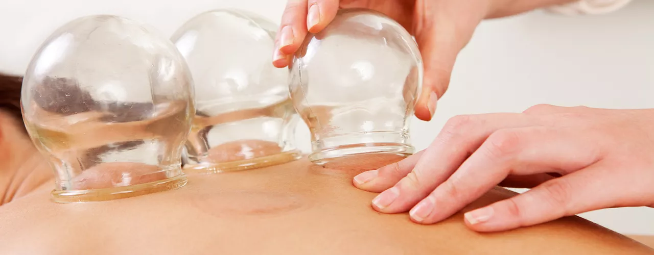 Cupping Therapy Modesto, CA